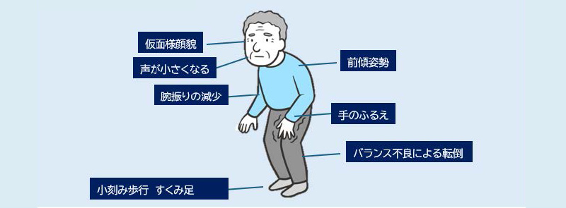 パーキンソン病の主な症状