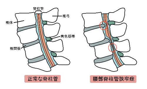 正常な脊柱管と腰部脊柱管狭窄